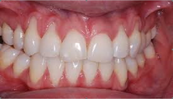 Tẩy trắng răng 8 2 1