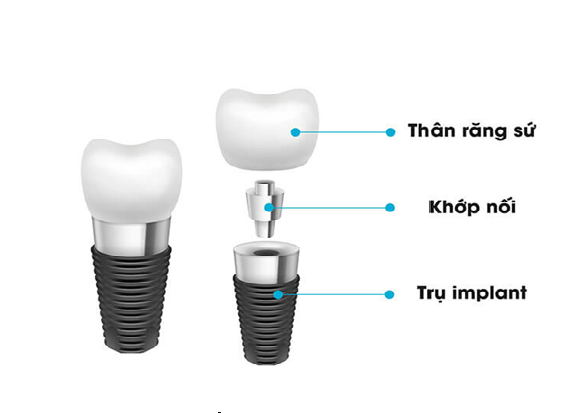 Cấy ghép Implant 5 Implant 1