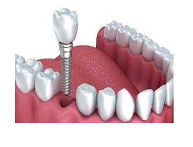 Cấy ghép Implant 6 Implant
